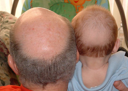 Generation of baldies