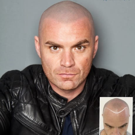 Before and after scalp micro pigmentation