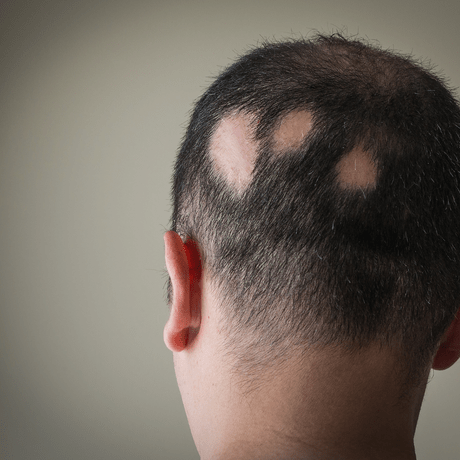 Signs of Alopecia