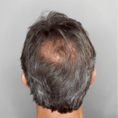 scalp micro pigmentation