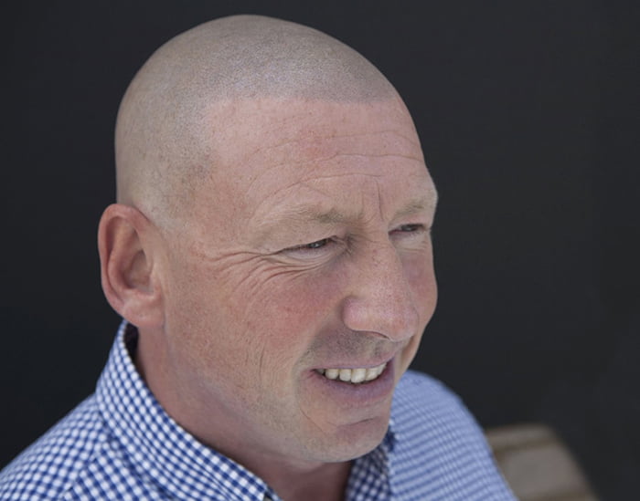 Roy After Scalp Micropigmentation 2