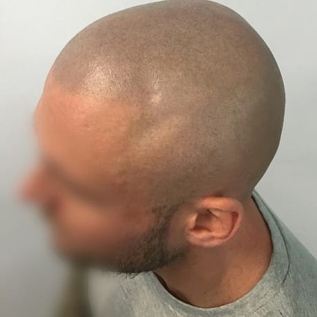 After 3rd session of scalp micropigmentation