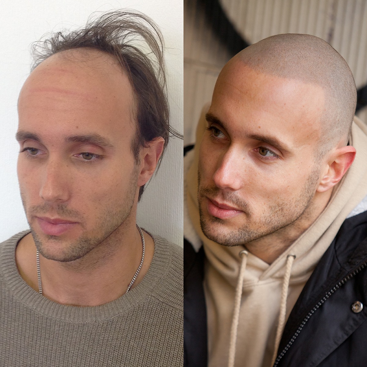 shiny scalps is a big problem among bald men