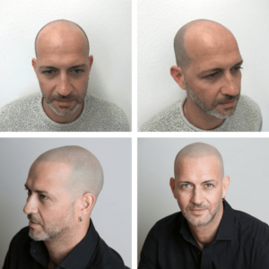 Top Hair Transplant Alternatives 2017 Skalp