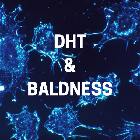 what is DHT's role in baldness and hairloss