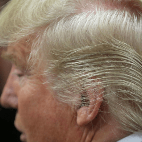 Has Trump Had Scalp Reduction Surgery- photo of trumps thinning hair