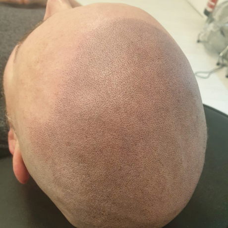 After 3rd Scalp micropigmentation session
