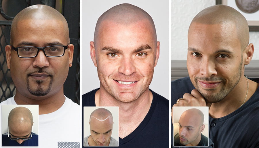 Scalp Micropigmentation Clinic Skalp