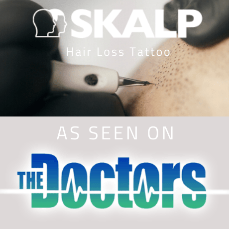 skalp hair loss tattoo on the doctors show