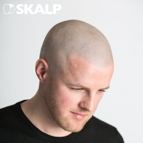 scalpmicropigmentation after on balding man