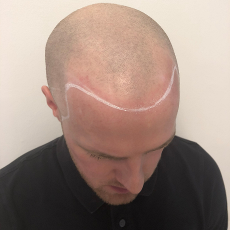 Ways To Know If You Are Going Bald- Scalp micropigmentation