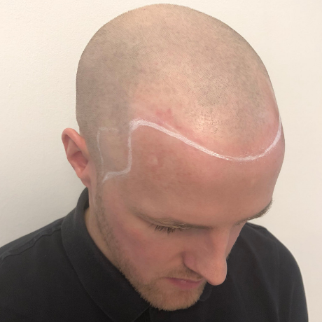 scalp micropigmentaiton before balding man