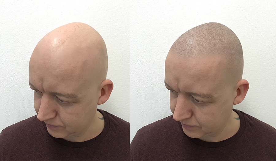 Virtual tattoo hairline mock-up of scalp micro pigmentation on ben from ttny
