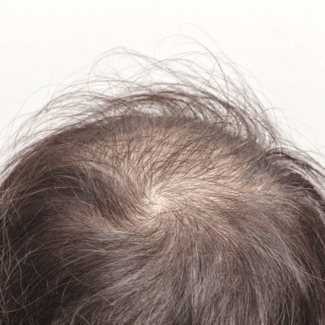 Eczema Drug That Also Grows Hair - Hair Loss Cure - Skalp