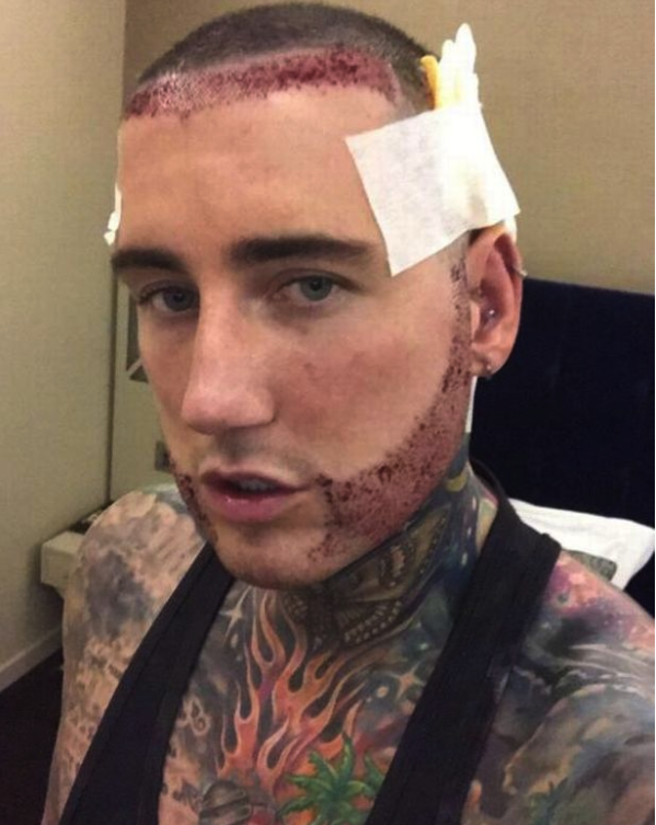 Jeremy McConnell Hair and Beard Transplant 