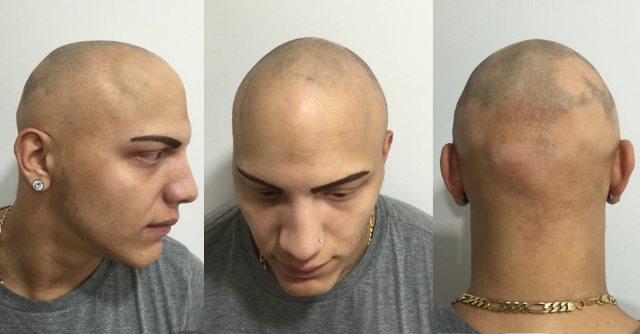 Alopecia Head Tattoo in New York Review - before Skalp Treatment