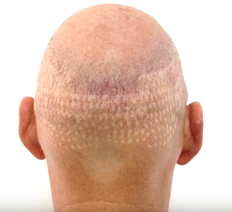 The Pros And Cons Of A DHI Hair Transplant