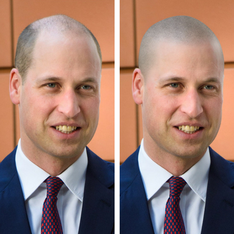 prince williams shaved head- should prince william get scalp micro pigmentation before and after