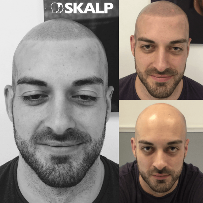 Richard before and after scalp treatment