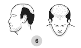 6th stage of male pattern baldness