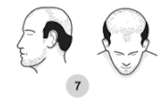 norwood hair loss scale stage 7
