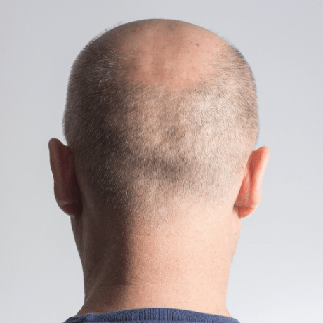 back of bald mans head