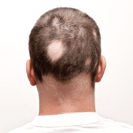 alopecia areata bald patches mans head