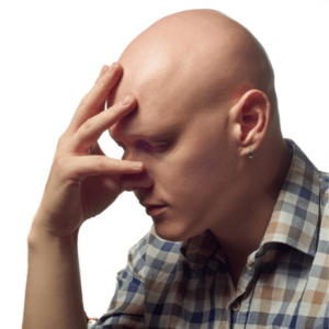 man with alopecia