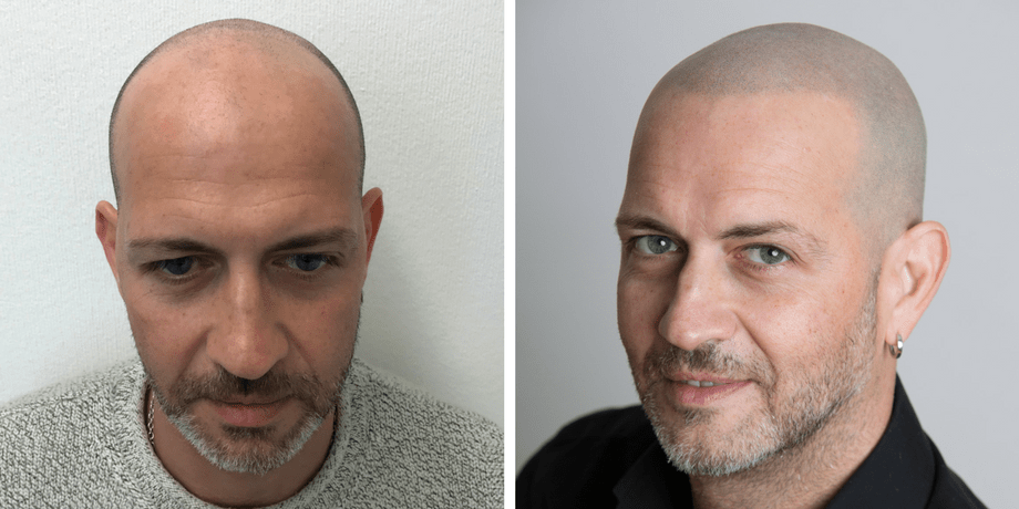 bald groom tips scalp micropigmentation
