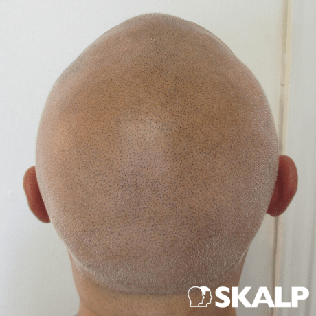 baldness cured with smp