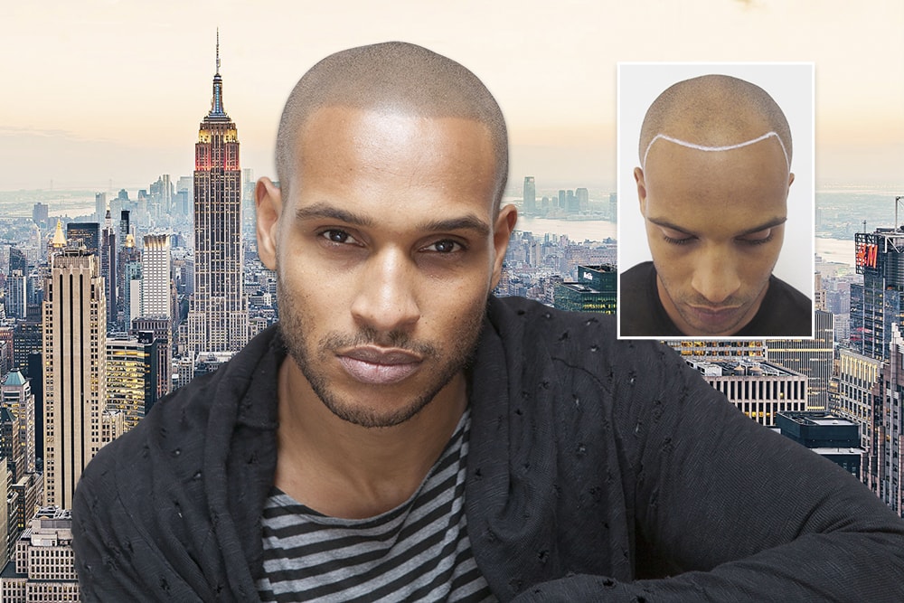 before and after hairline micropigmentation in nyc at skalp usa