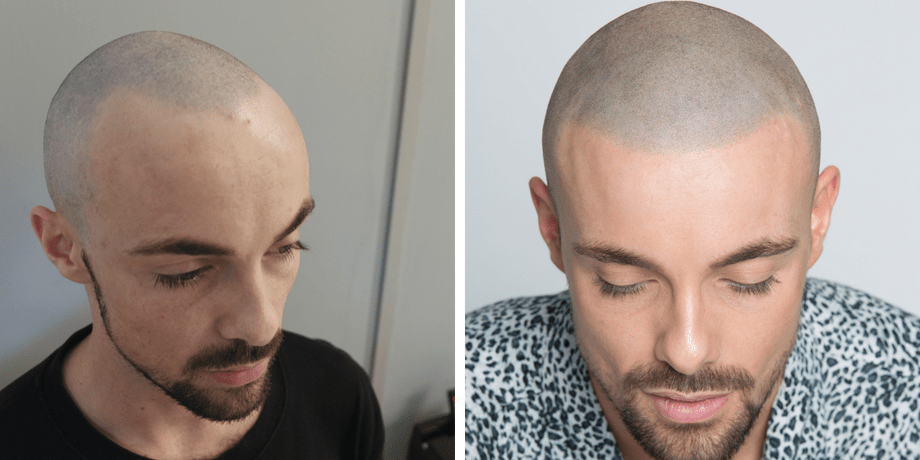 before and after SMP hairline restoration for receding hairline