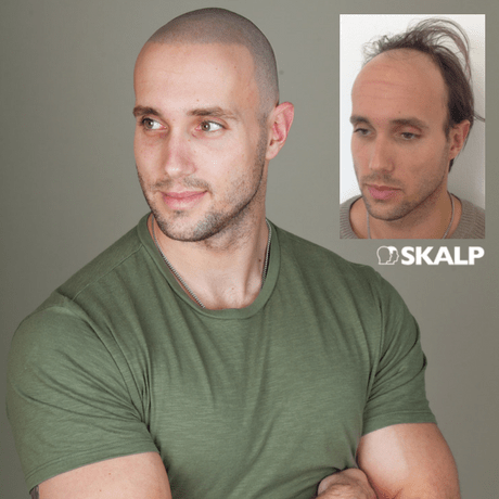 Scalp micro pigmentation prevent male pattern baldness