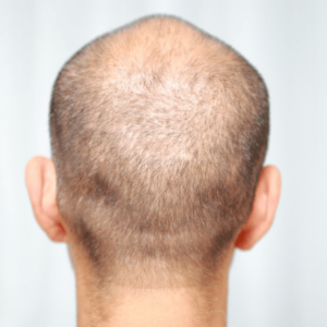 can collagen help with hair loss