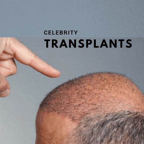 Celebrity hair transplants in the news rightnow. Finger pointing at a hair transplant hair