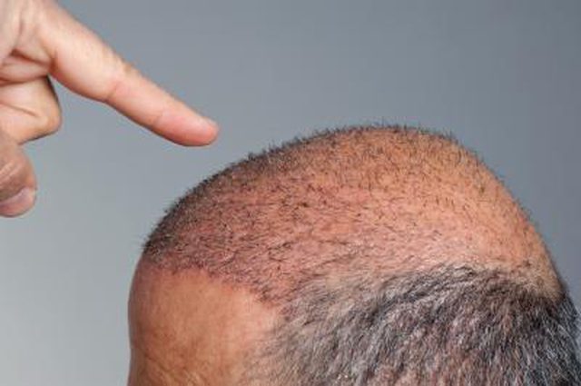hair transplant hair on a bald man