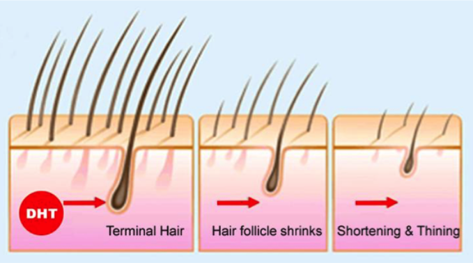 How exactly does DHT's role on baldness cause hair loss?
