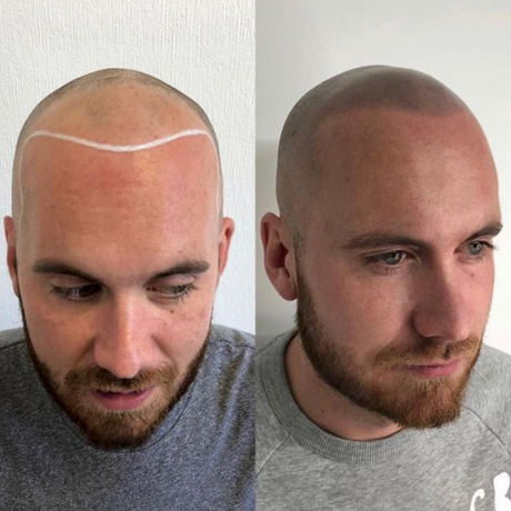 does Scalp Micropigmentation look real?