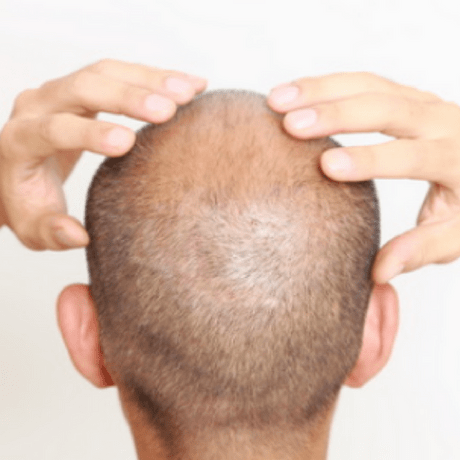 does drug use speed up hair loss? Cocaine and hair loss