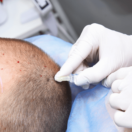 prp treatment in process for hair growth