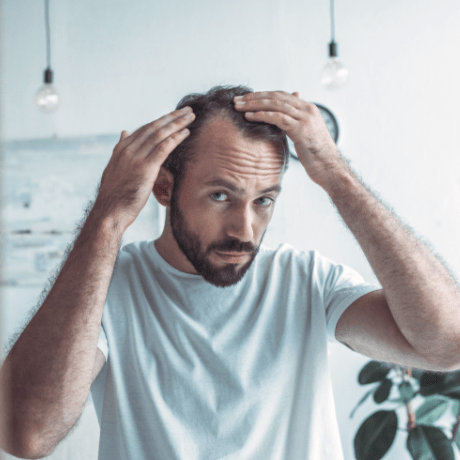 man with hair loss and anxiety