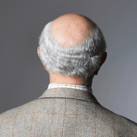 hair-loss-herreditary