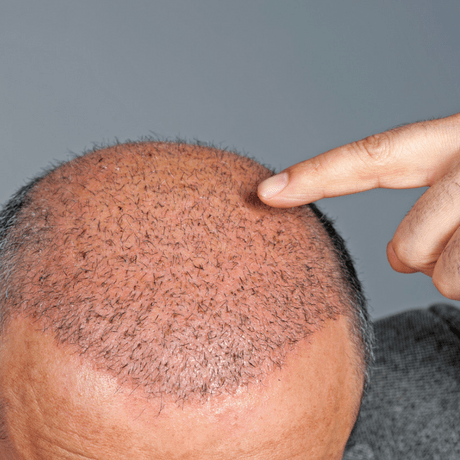 hair transplant for receding hairline in 20s