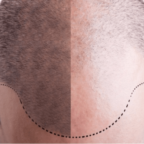 male pattern baldness example