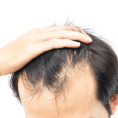 man with receding hairline at the temples of his head- Ways To Know If You Are Going Bald