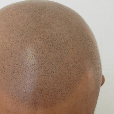 scalp micropigmentation close up