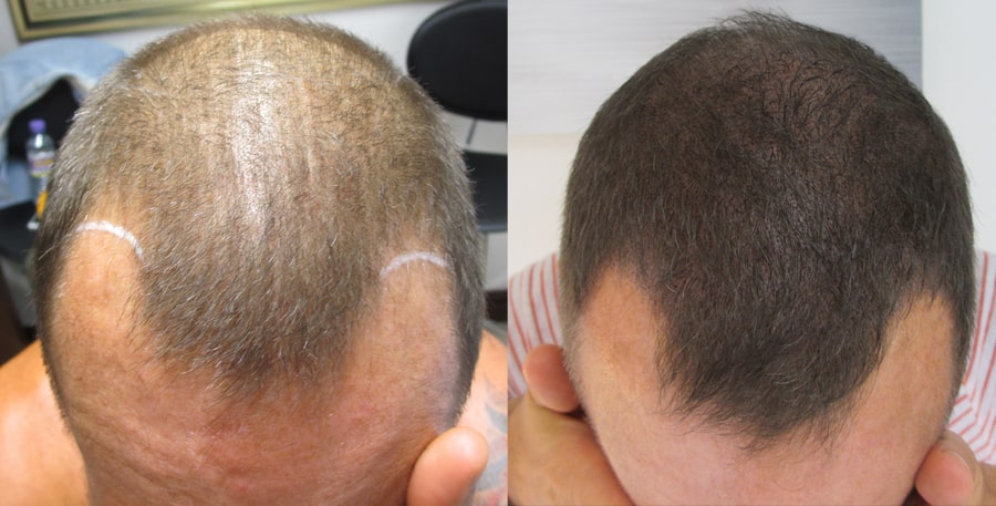 scalp micropigmentation with long hair