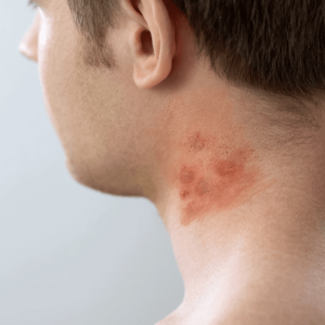 man with scalp psoriasis on neck