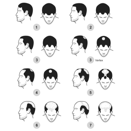 The 7 Stages Of Male Pattern Baldness