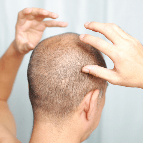man coping with hair loss